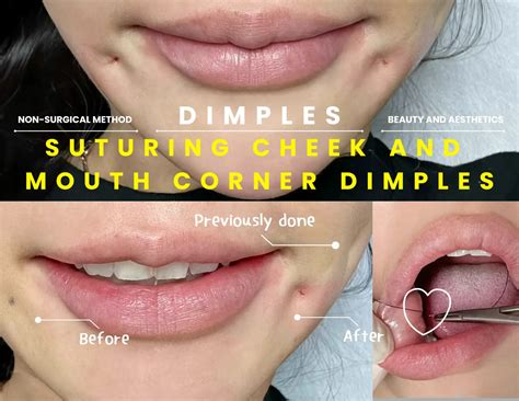 Korean Dimple Surgery