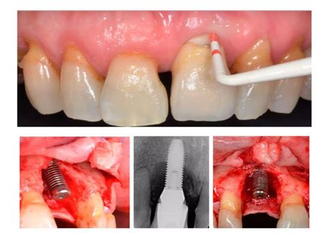Implant maintenance | PPTX