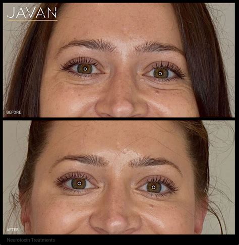 Neurotoxin Treatments - Javan Anti-Aging and Wellness Institute