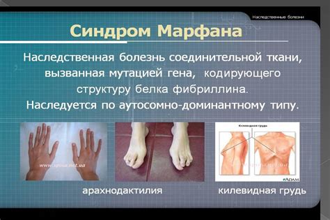 Синдром Марфана - Презентации по биологии