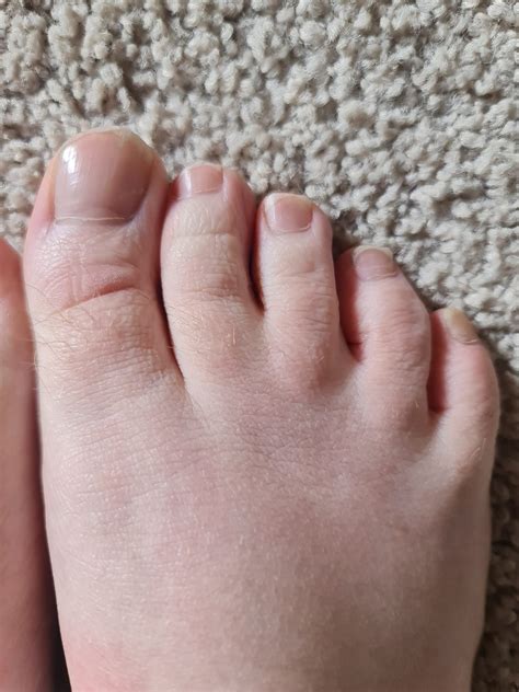 Introduction to my webbed toes and feet. Left foot is more webbed then