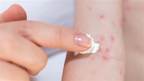 Treating An Allergic Skin Reaction (Contact Dermatitis), 46% OFF