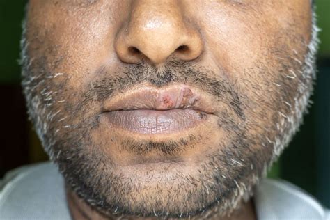 The Difference Between Canker Sores and Cold Sores