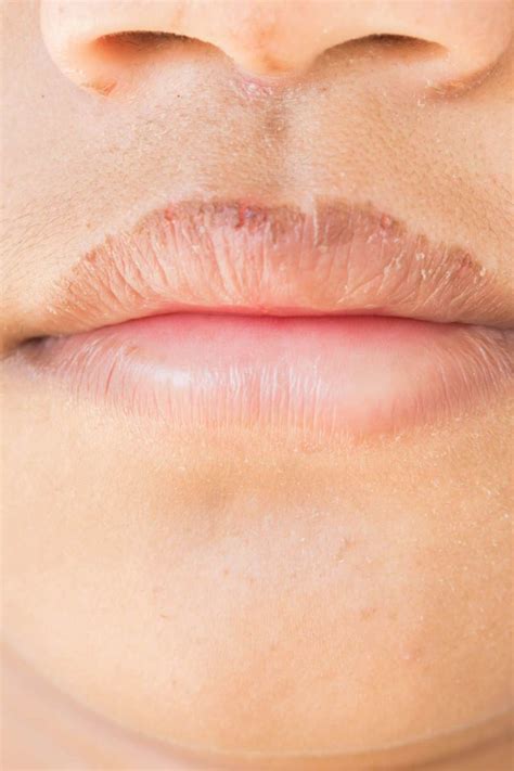 Crusty Lips