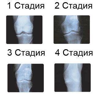 Степени артроза колена