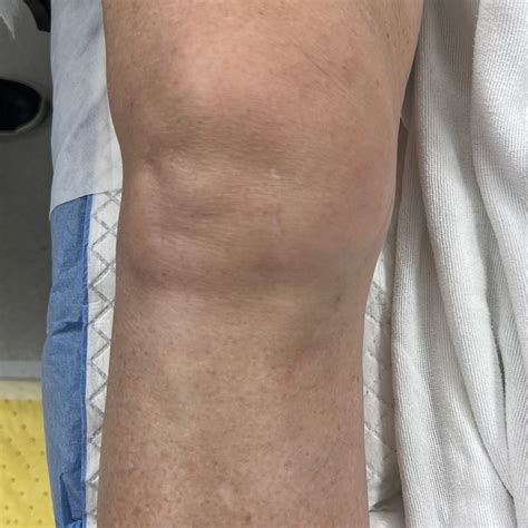 What will my scar look like? — Andreas H. Gomoll, MD