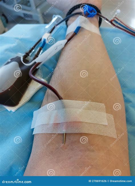 Needle Stuck in Blood Young Person Arm during Blood Transfusio Stock