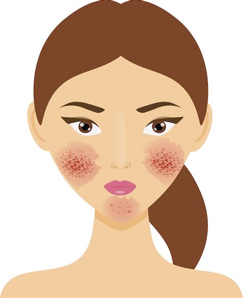 What Is Rosacea & How a 5-Step K-Beauty Routine Can Help You Manage It