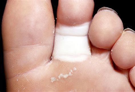 Raynaud’s disease - Red, White, and Blue Toes | Health Beauty and Wellness