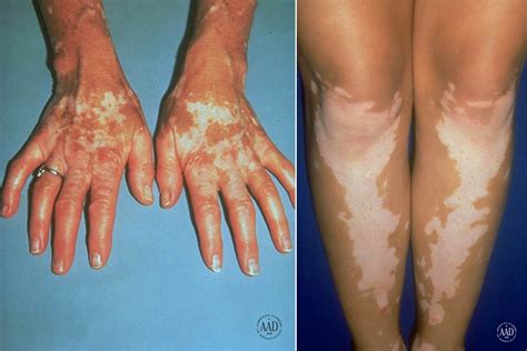 Why Do I Have White Spots On My Skin That Itch - Infoupdate.org