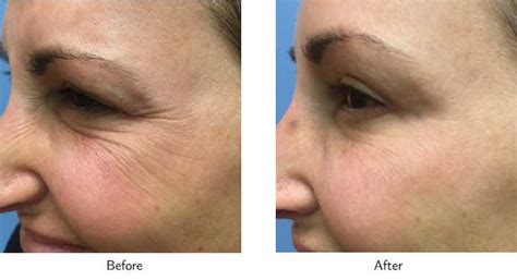 wrinkle treatments    gold coast plastic surgery