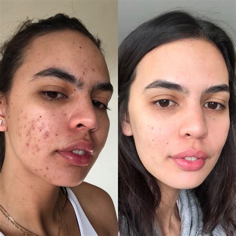 Forms Of Birth Control Accutane at Jessica Hamlin blog