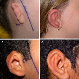 ear splinting  obliteration   retroauricular sulcus due  skin