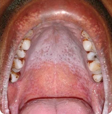 Nicotinic Stomatitis Object Detection Dataset and Pre-Trained Model by ...