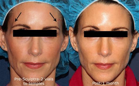 sculptra collagen injections cosmetic laser dermatology