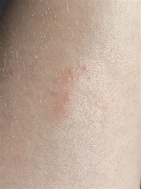 bumpy rash appeared     ideas rdermatologyquestions