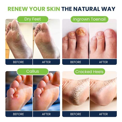 home treatment for fungus on feet 6