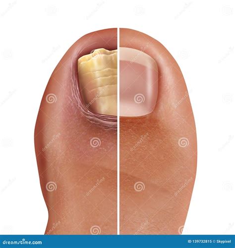 Fungal Nail Infection stock illustration. Illustration of fungal