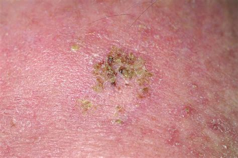 Solar Keratosis Growth On Forehead Photograph by Dr P. Marazzi/science ...