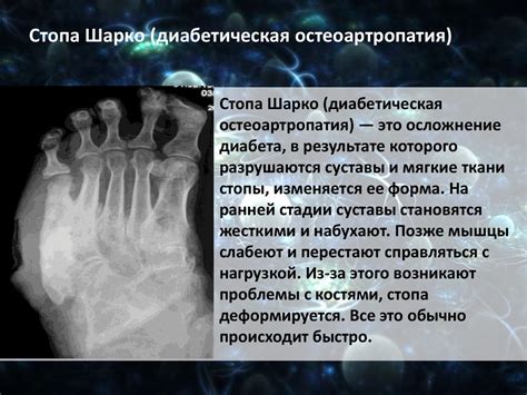 Диабетическая стопа - презентация онлайн