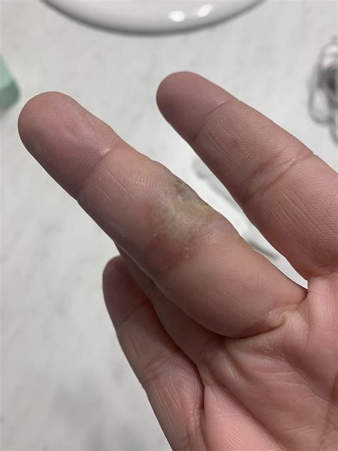 Herpetic Whitlow or Dyshdriotic Eczema? : r/DermatologyQuestions