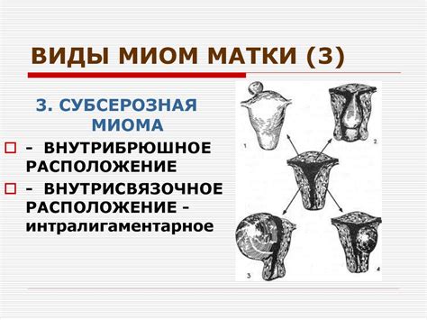 Миома матки - презентация онлайн