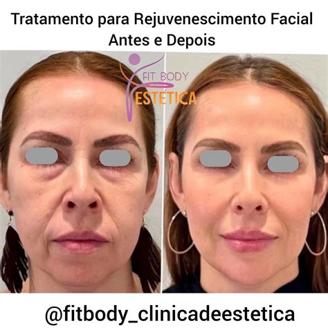 Qual O Melhor Procedimento Para Rejuvenescer O Rosto