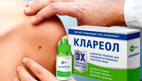10 лучших мазей от папиллом: описание препаратов, примерные цены