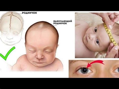 Гидроцефалия головного мозга у детей: причины, последствия, лечение ...