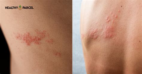 Staph Infection: Causes and Symptoms