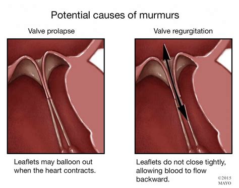heart murmur   innocent   mayo clinic news network
