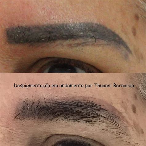 Despigmentação De Sobrancelha 2