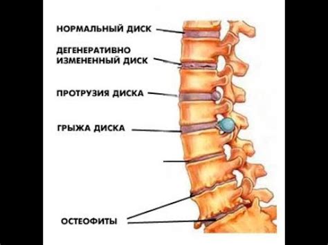 Лечение Грыж Позвоночника. Артрозов Суставов. (врач Остеопат) - YouTube