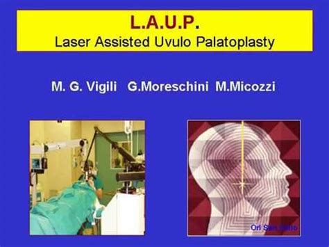 Uvulopalatoplastica - YouTube