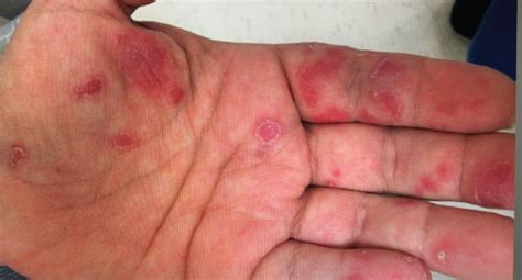 Image Case Report: Refractory, Acute, Cutaneous Lupus - The Rheumatologist