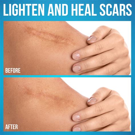 JJ CARE Silicone Scar Sheets (1.5" x 3") Medical Silicone Scar Removal