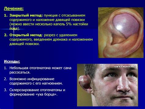 Острые заболевания уха. Наружный отит, острый средний отит. Мастоидит ...