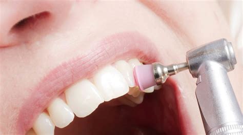 Limpeza dentária - Adriana Lànger | Odontologia Estética