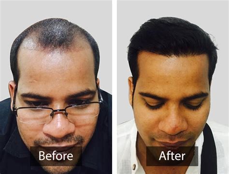 Cutis International | Hair Transplant Clinic in Kochi – Hair Loss ...