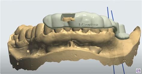 3D водено поставяне на импланти - представяне на клиничен случай с ...