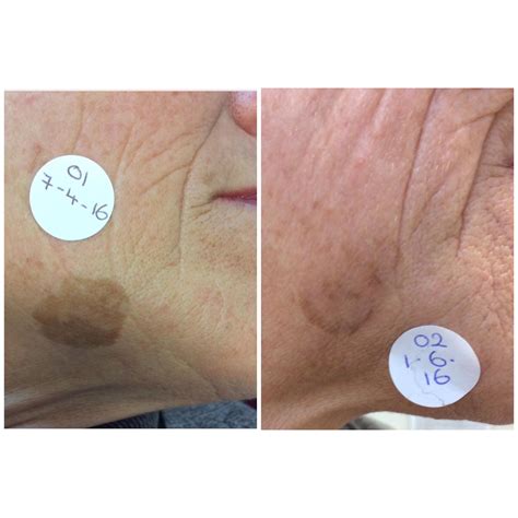 Laser precision will soon define the future of hair cut fade 20