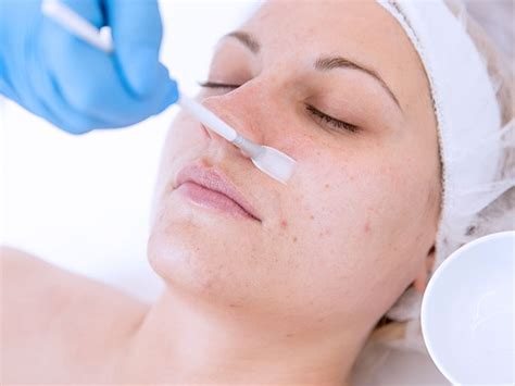 chemical peel how long does it take to heal