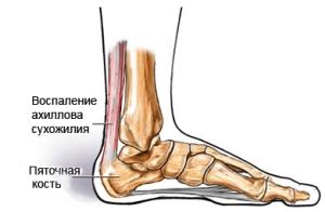 Энтезопатия коленного, плечевого, тазобедренного суставов и стоп