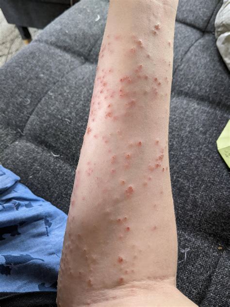 Dermatitis Herpetiformis Legs Dermatitis Herpetiformis | The College