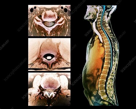 Backbone and spinal cord anatomy, MRI scans - Stock Image - C033/7530 ...