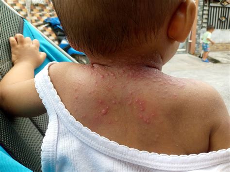 Heat Rash On Back