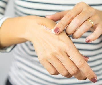 Scars 101 - Causes, Types, Treatments & Prevention | Dermacare Direct