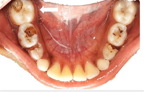 Pre-operative intraoral image Deep occlusal caries associated with the ...