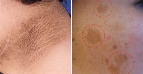 Manchas Pelo Corpo O Que Pode Ser - 6 Tipos de manchas na pele: como tratar e o que NÃO fazer