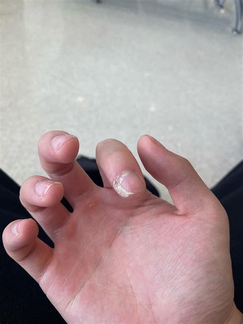 Super quick diagnosis help (no pain no discomfort) : r/DiagnoseMe